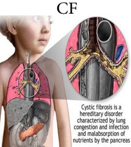 یماری CFیا Cystic fibros